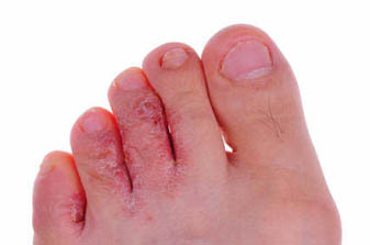 athletes foot